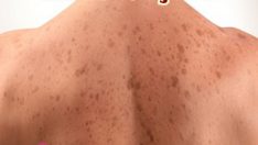 Güneş Lekeleri Nasıl Geçer Diyenlere 4 Doğal Maske