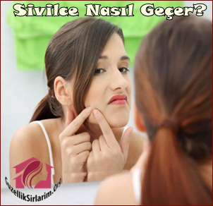Sivilce Nasıl Geçer? Doğal Yöntemlerle Sivilcelerden Kurtulma Rehberi