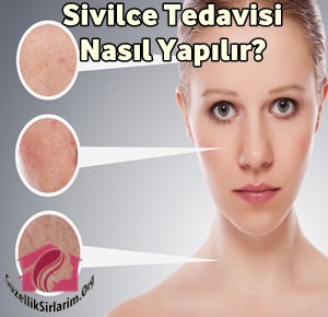 Sivilce Tedavisi Nasıl Yapılır, Ne Kadar Sürer?