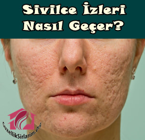 Sivilce İzleri Nasıl Yok Edilir?