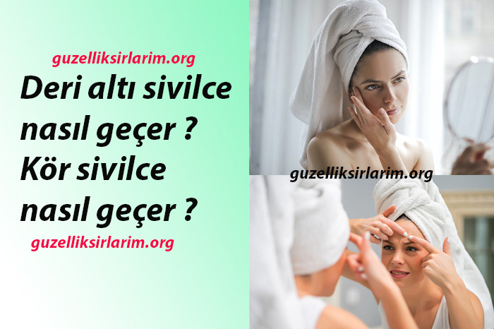 Deri altı sivilce nasıl geçer ? , Kör sivilce nasıl geçer ?