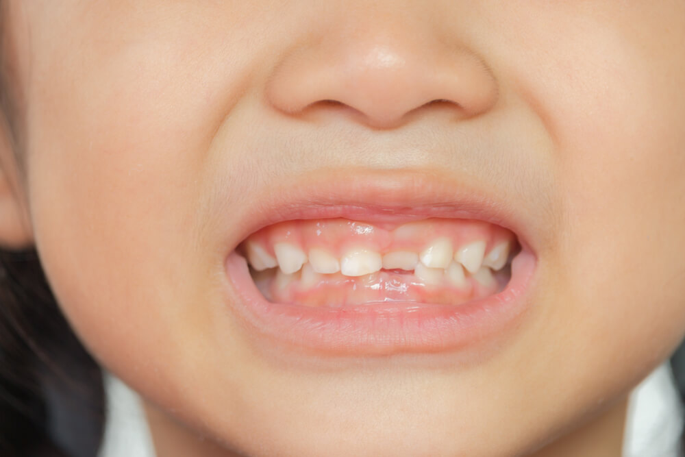 Çocuklarda Diş Gıcırdatması
